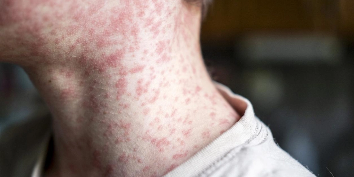 Le doute qui a permis le retour de la rougeole